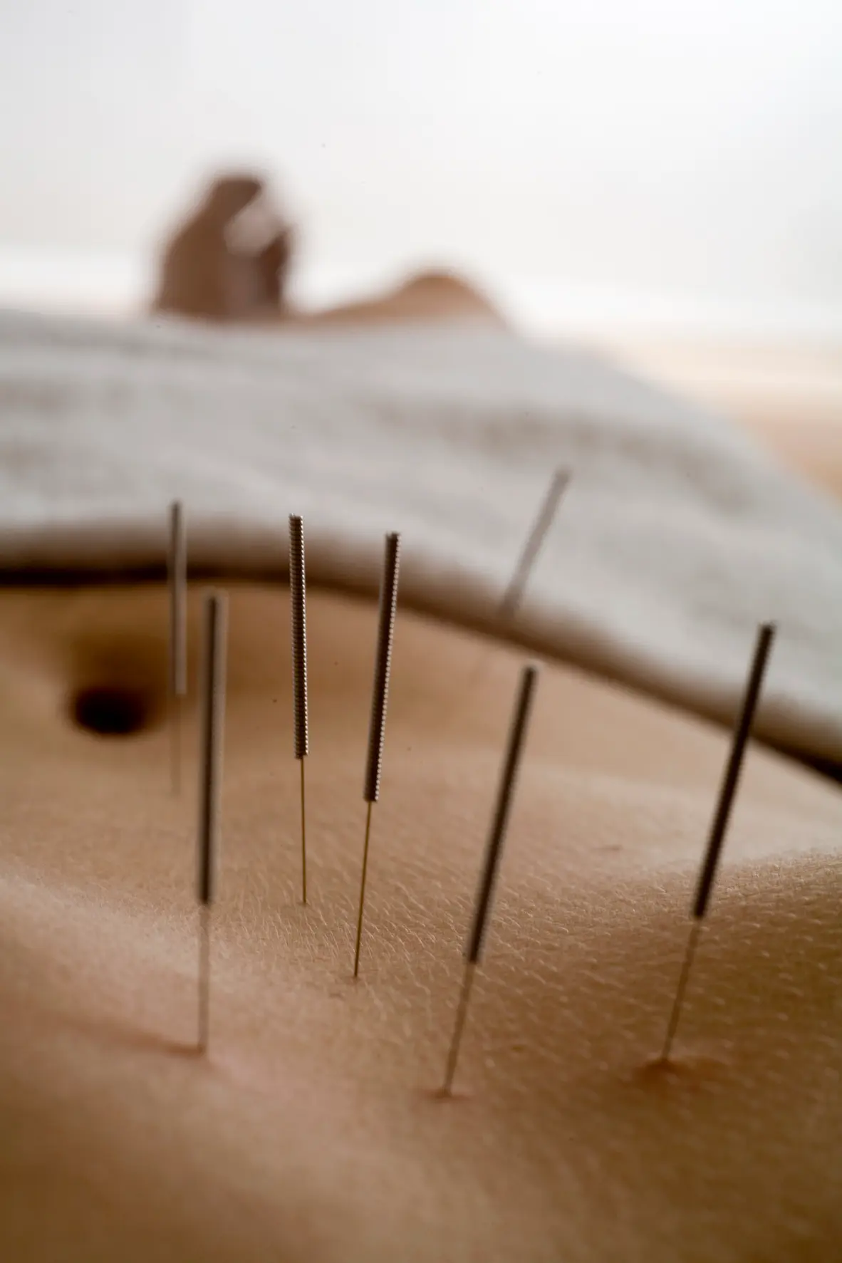 Acupuncture
