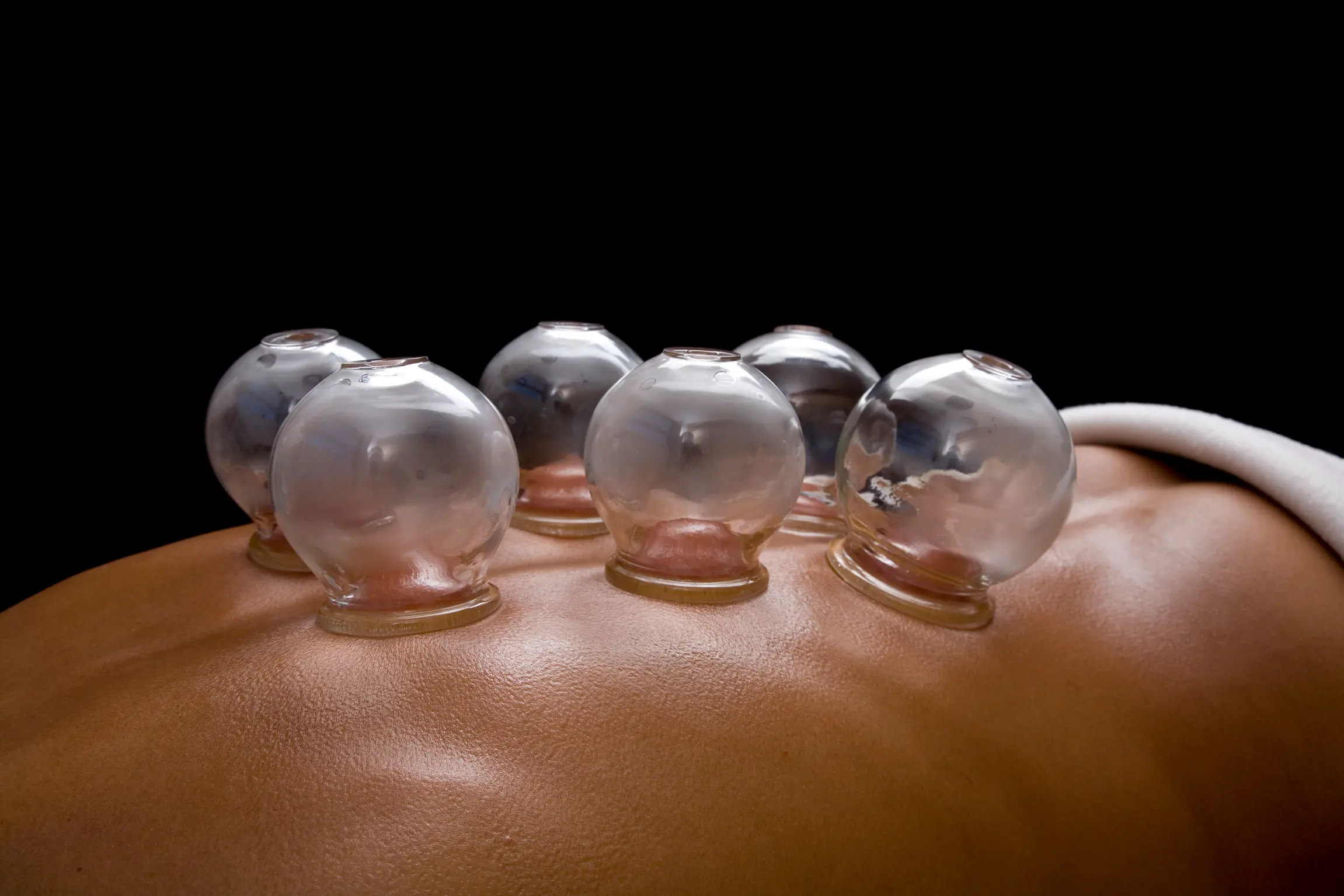 Cupping